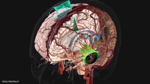 Accelerate AI Workflows for 3D Medical Imaging with NVIDIA MONAI Cloud APIs