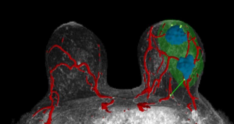 Startup Helps Surgeons Target Breast Cancers With AI-Powered 3D Visualizations