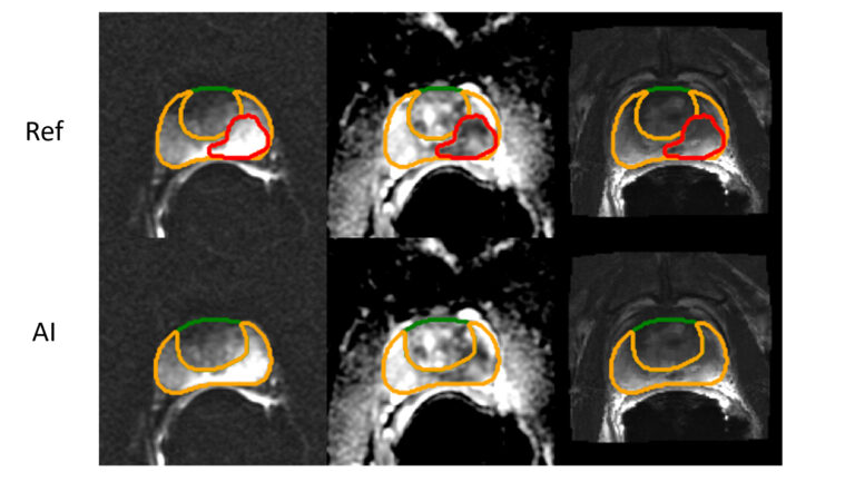 AI Research Delivers Rapid, Accurate Prostate Cancer Predictions