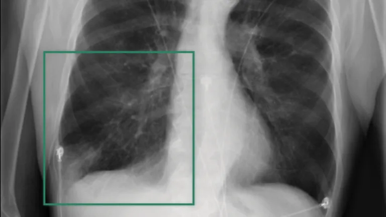 Advancing Explainable AI in Radiology Research with NVIDIA Clara Reason